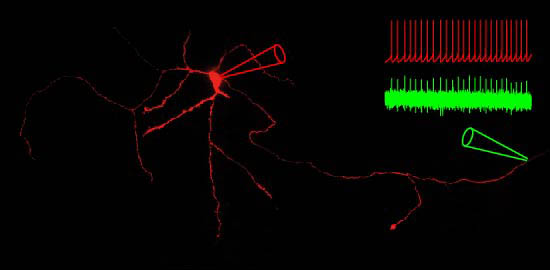 Subthalamic nucleus neuron