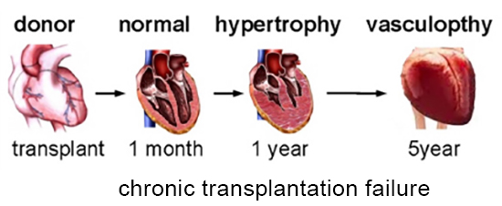 image of chronic reprogramming of single cells; donor transplant to normal in one month to hypertrophy in one year to vasculopathy in five years to graft failure in 10 years 