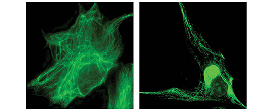 Intermediate filaments in neurodegenerative disease