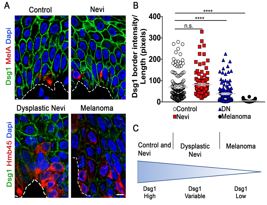 KC Dsg1 is reduced in dysplastic nevi 