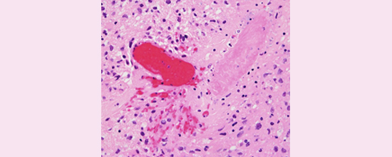 Microthrombus in a glioblastoma