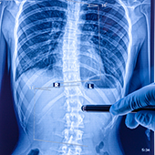 New Scoliosis Research Could Lead to Earlier Treatments