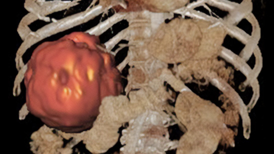 3D medical image showing abdominal tumor