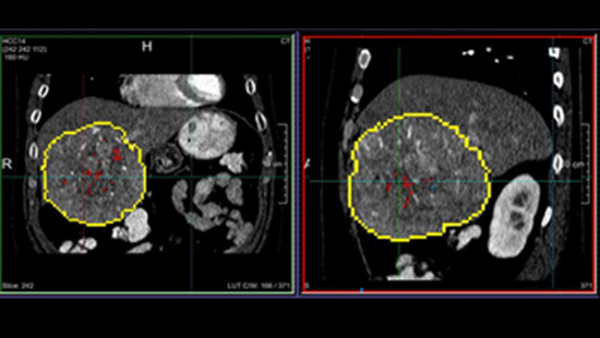 medical scan highlighting tumor area