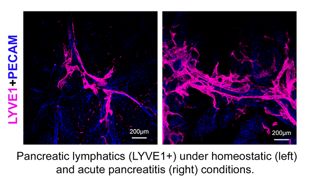 Lymphatics in pancreatitisy