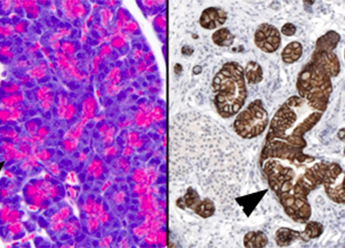 Acinar Differenain