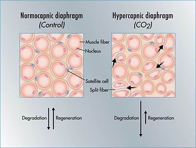 hypercapnia symptoms dead space in lungs