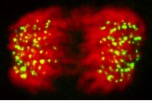 Cancer cell undergoing erroneous chromosome segregation at anaphase