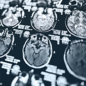 Non-invasive Approach Predicts Chemotherapy Response in Glioblastoma