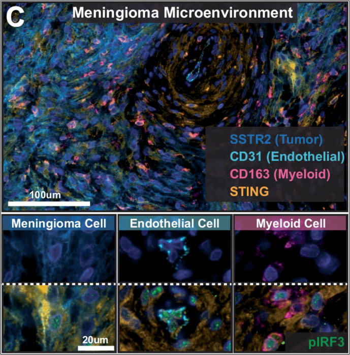 Microscopy images of the meningioma tumor microenvironment showing tumor, endothelial and myeloid cells and STING pathway activation.